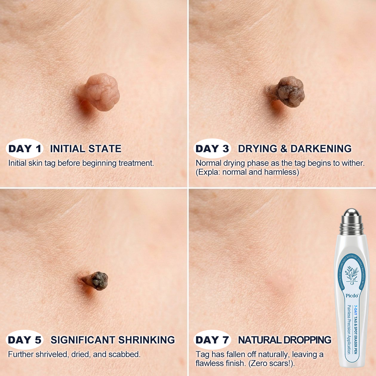 RamiraClear™ — Melt Away Blemishes Pain-Free and Reveal Radiant Skin in Just 7 Days