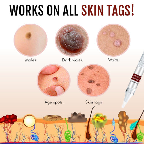 ClearRadiance™ — Fade Warts Fast and Reveal Skin You’re Proud to Show Off (1+1 FREE TODAY!)