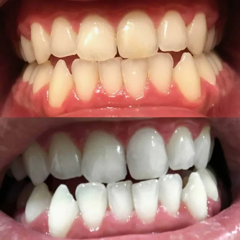 LumaLux™ — Instantly Boost Your Confidence with a Brighter, Radiant Smile