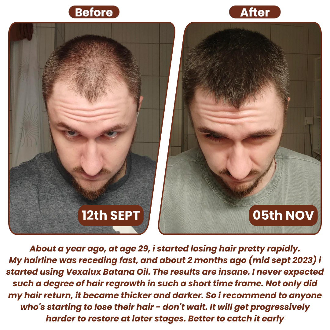 (1+1 FREE) Caremey™ — Transform Thinning Hair into a Bold, Thick Crown in Just 14 Days