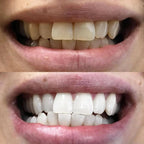 LumaLux™ — Instantly Boost Your Confidence with a Brighter, Radiant Smile