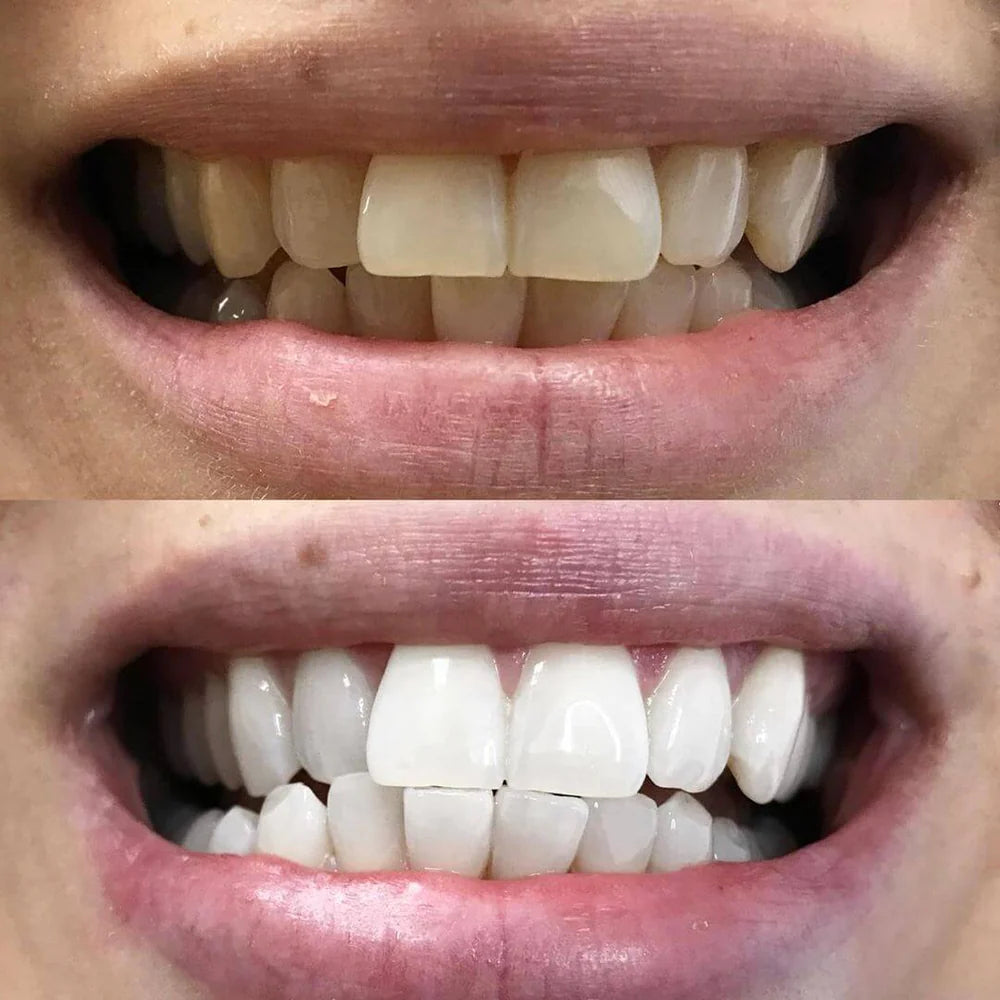 LumaLux™ — Instantly Boost Your Confidence with a Brighter, Radiant Smile