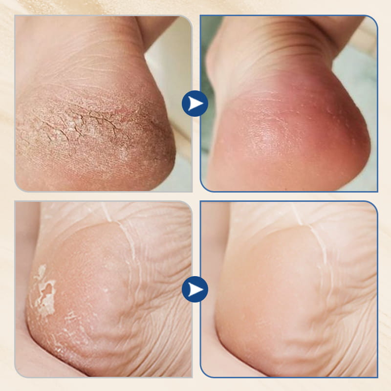 SoleSerene™ — Transform Your Feet into a Silky, Crack-Free Comfort Zone