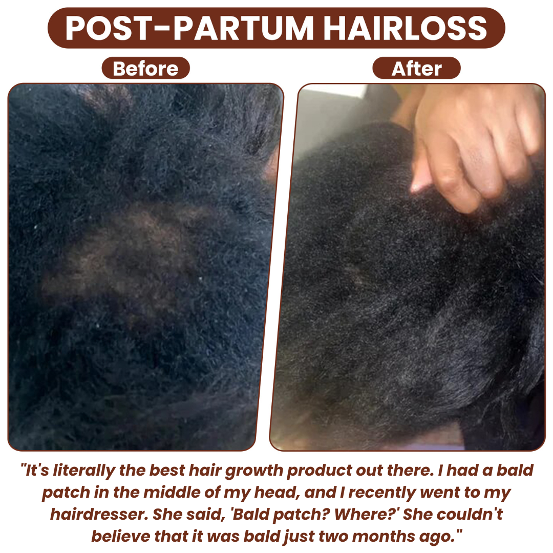 (1+1 FREE) Caremey™ — Transform Thinning Hair into a Bold, Thick Crown in Just 14 Days