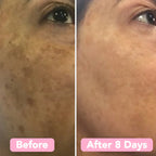 CleanPro™ — Reveal Your Radiant Glow by Fading Dark Spots Fast