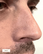Hydro-Absorb™ Nose Patch — Wake Up to Smooth, Shine-Free Skin You Crave (8 Patches/box)