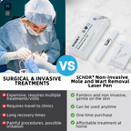 SCNDR® 🏅Non-Invasive Mole and Wart Removal Laser Pen