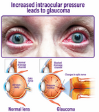 VisionRise™ — Awaken Youthful, Vibrant Vision Without Surgery or Drops