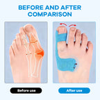 SolaceStep™ — Walk Pain-Free with Invisible, All-Day Bunion Relief