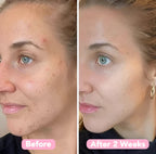 CleanPro™ — Reveal Your Radiant Glow by Fading Dark Spots Fast