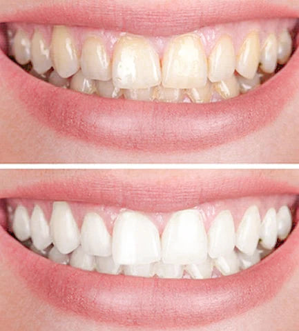 FlashSmile™ — Unleash Radiant Confidence with a Pain-Free, Brilliant Smile