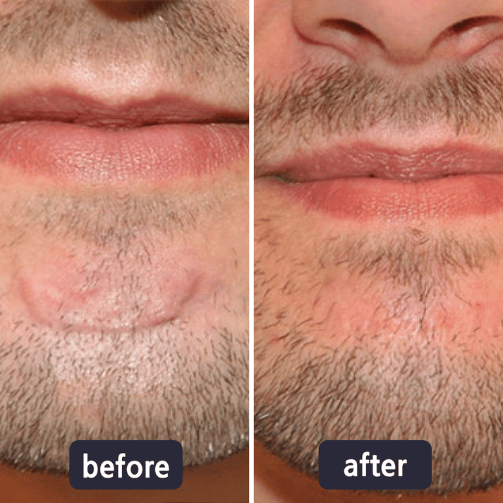 GlowSilk™ — Watch Scars Disappear and Reveal Radiant, Youthful Skin Instantly