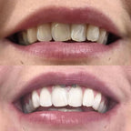 LumaLux™ — Instantly Boost Your Confidence with a Brighter, Radiant Smile