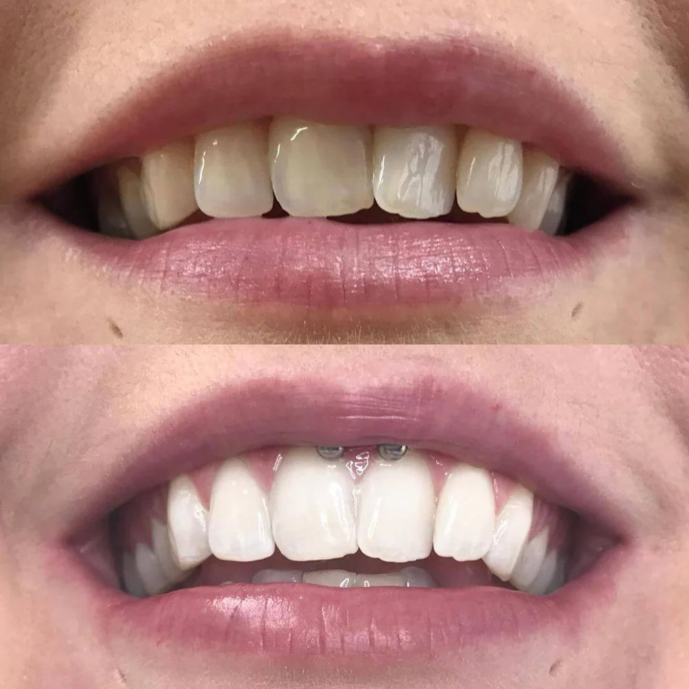 LumaLux™ — Instantly Boost Your Confidence with a Brighter, Radiant Smile