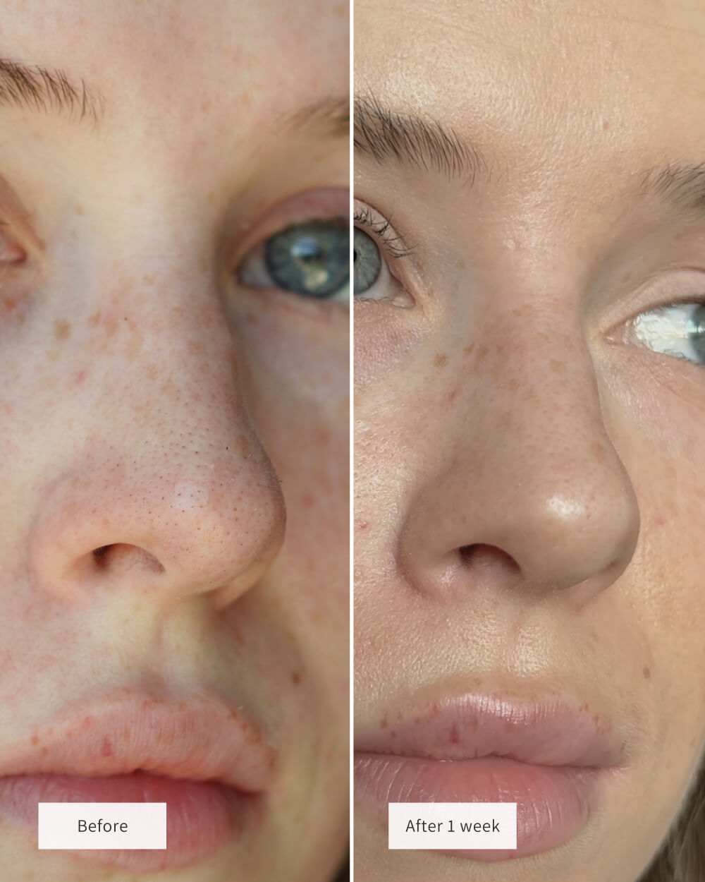 Hydro-Absorb™ Nose Patch — Wake Up to Smooth, Shine-Free Skin You Crave (8 Patches/box)