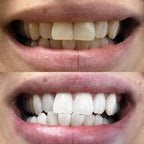 Color Correction Tooth Whitening Pen