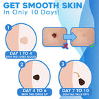 ClearSkinX™ — Zap Warts Fast and Unleash Your Radiant, Head-Turning Skin (FULL KIT)