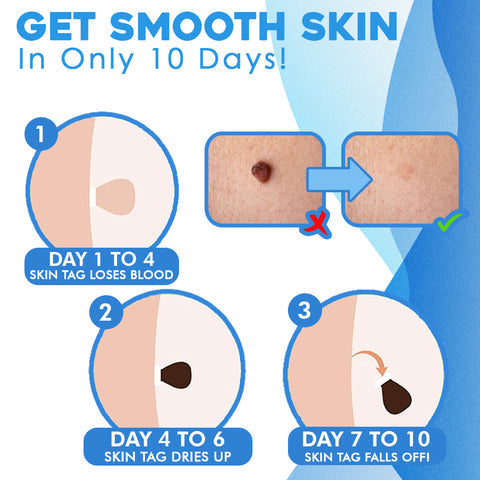 ClearSkinX™ — Zap Warts Fast and Unleash Your Radiant, Head-Turning Skin (FULL KIT)