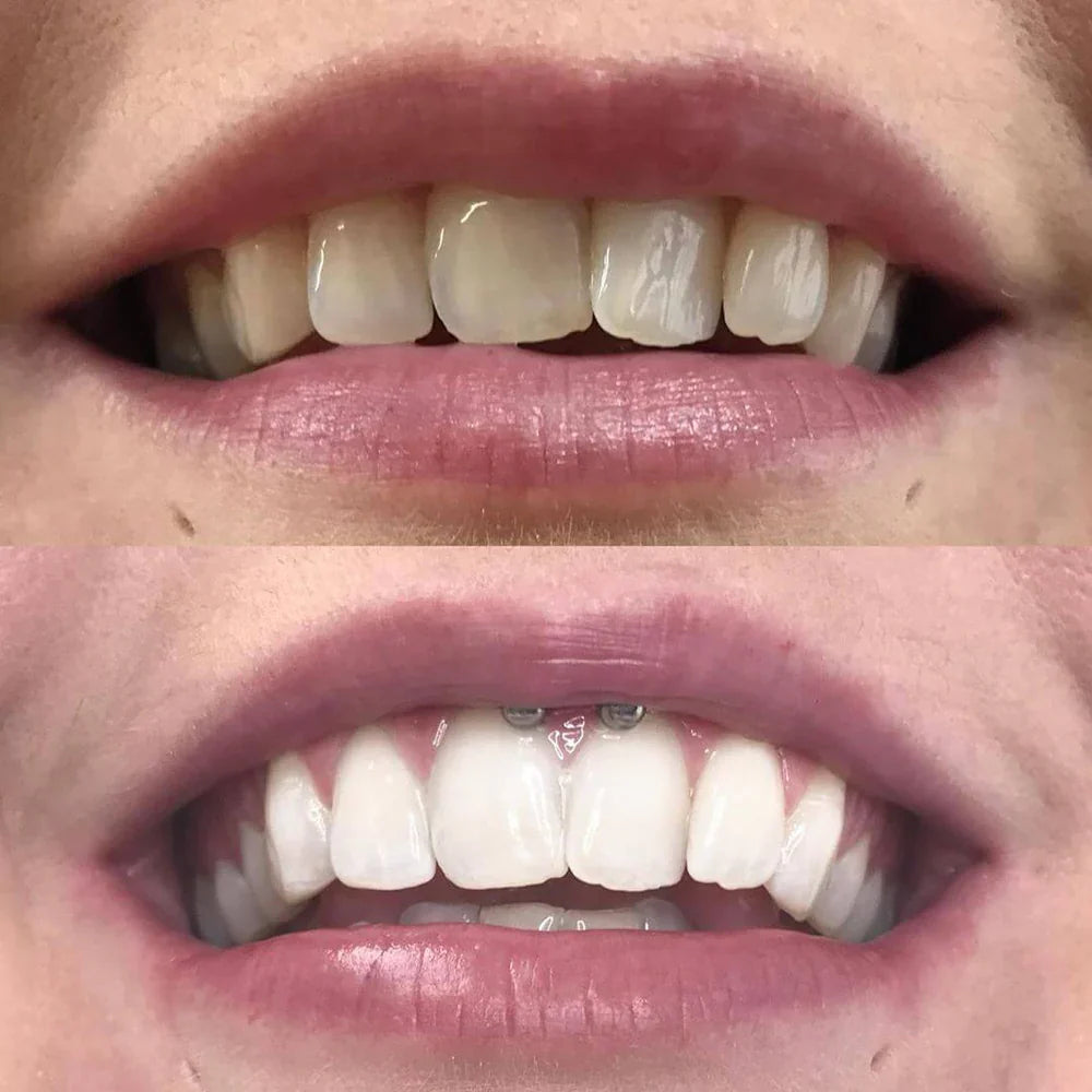 Color Correction Tooth Whitening Pen