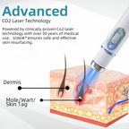 SCNDR® 🏅Non-Invasive Mole and Wart Removal Laser Pen