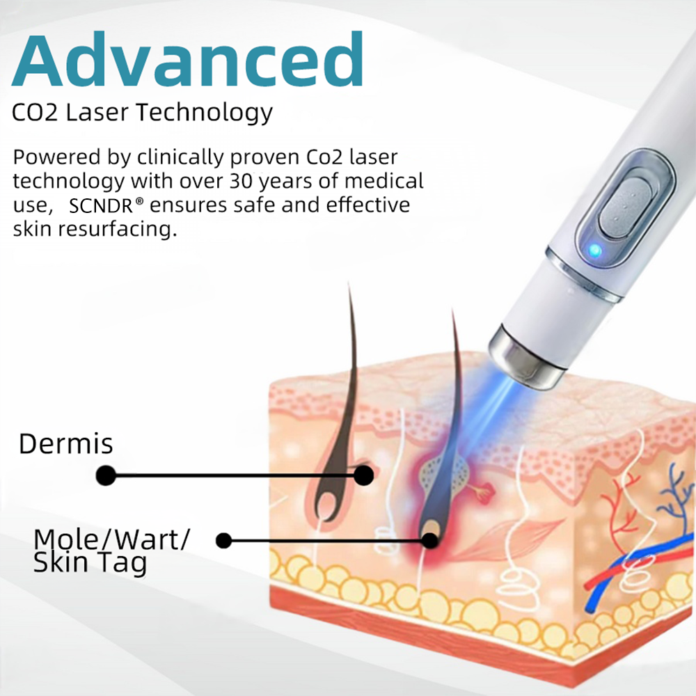 SCNDR® 🏅Non-Invasive Mole and Wart Removal Laser Pen