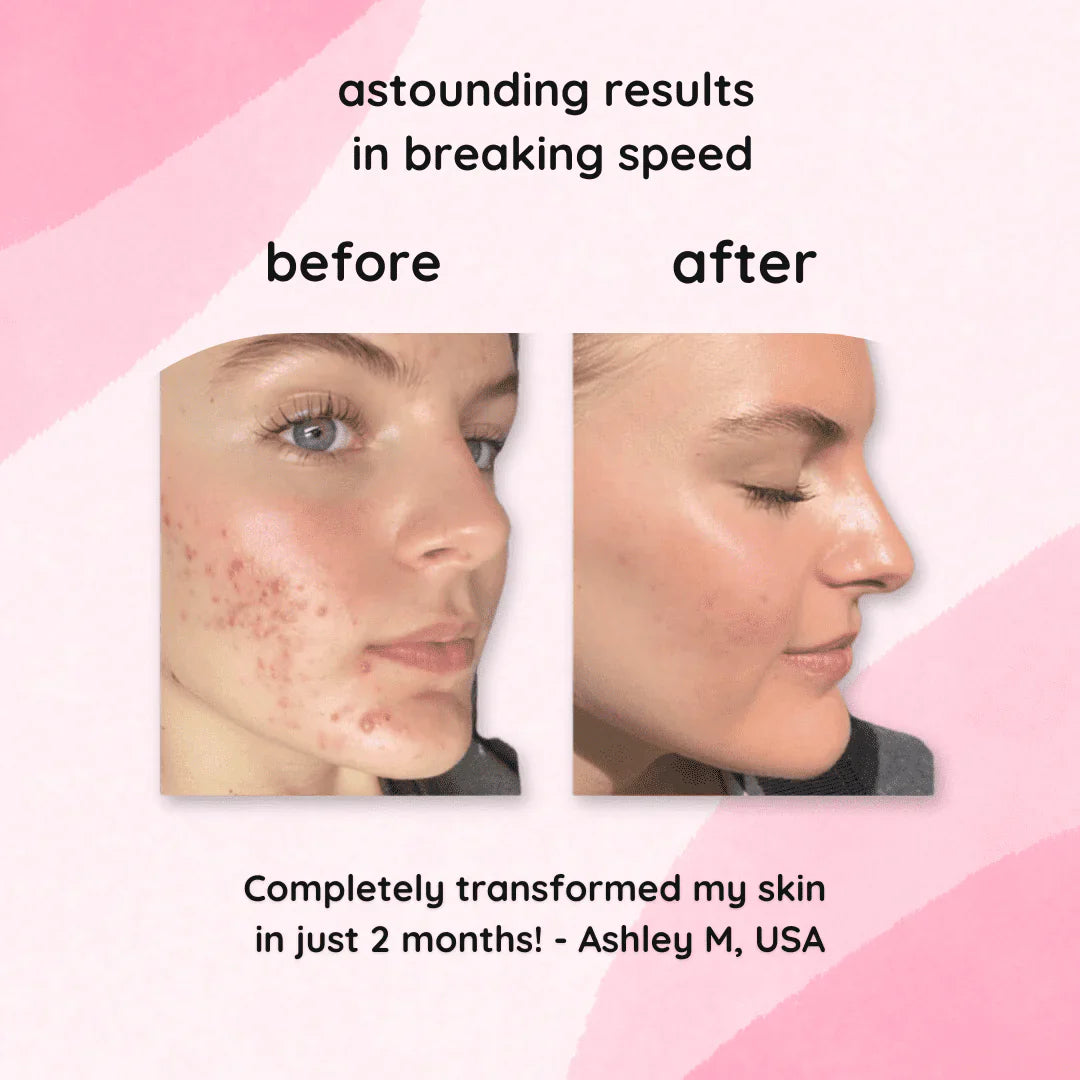 CleanPro™ — Reveal Your Radiant Glow by Fading Dark Spots Fast