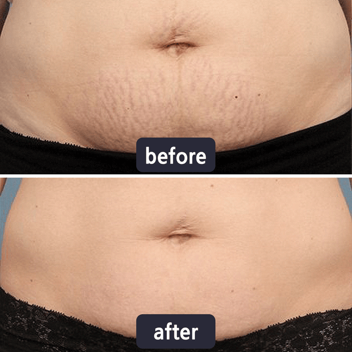GlowSilk™ — Watch Scars Disappear and Reveal Radiant, Youthful Skin Instantly