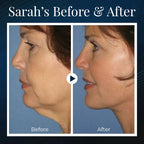 ViveLift™ — Effortless, All-Day Sculpting for a Jawline That Commands Attention