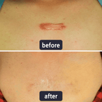GlowSilk™ — Watch Scars Disappear and Reveal Radiant, Youthful Skin Instantly