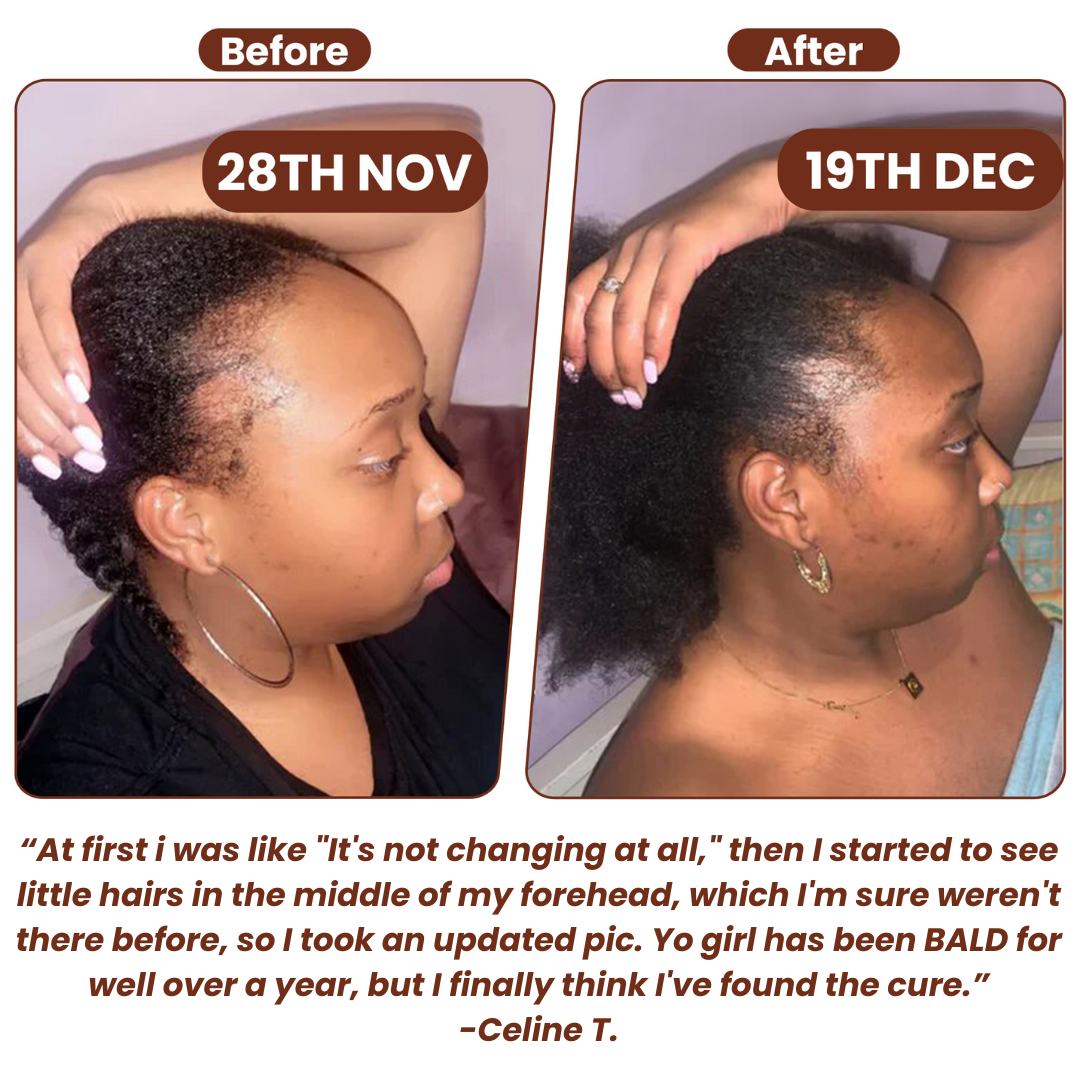 (1+1 FREE) Caremey™ — Transform Thinning Hair into a Bold, Thick Crown in Just 14 Days