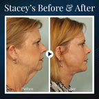 ViveLift™ — Effortless, All-Day Sculpting for a Jawline That Commands Attention