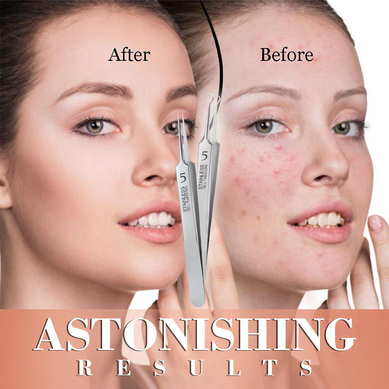 DermaSculpt™ Tweezers Set — Unlock Flawless, Confident Skin with Precise, Pain-Free Extraction