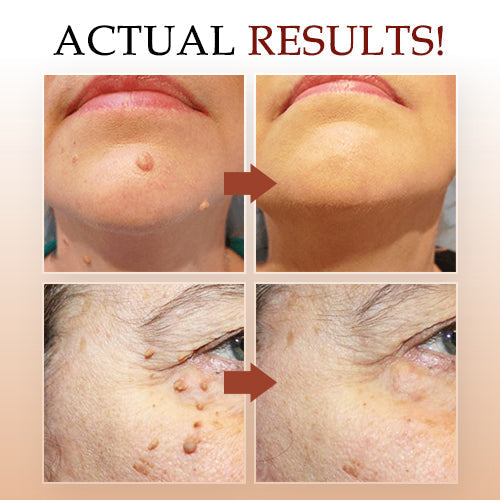 ClearRadiance™ — Fade Warts Fast and Reveal Skin You’re Proud to Show Off (1+1 FREE TODAY!)