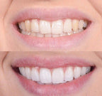 FlashSmile™ — Unleash Radiant Confidence with a Pain-Free, Brilliant Smile