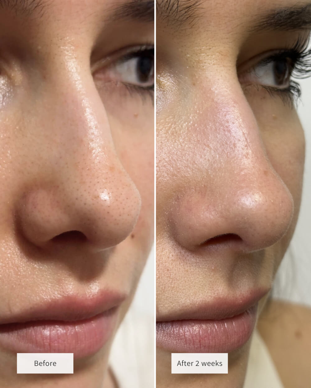 Hydro-Absorb™ Nose Patch — Wake Up to Smooth, Shine-Free Skin You Crave (8 Patches/box)
